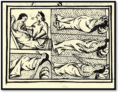 A 16th-century print showing the progression of smallpox in a Native American victim of the disease.